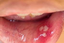 Image result for Lip Papilloma