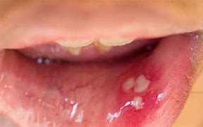 Image result for HPV On Uvula