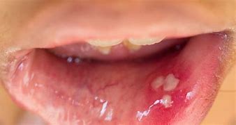 Image result for Papilloma Wart Tongue