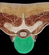 Image result for Vertebral Body Hemangioma CT