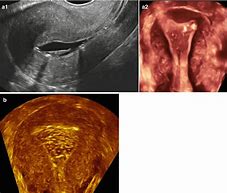 Image result for Pedunculated Polyp Uterus