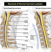Image result for Cervical Spine Lordosis