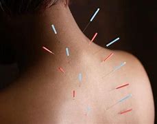 Image result for Acupuncture Chronic Pain