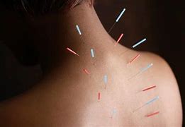 Image result for Acupuncture Chronic Pain