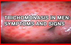 Image result for Trichomoniasis Rash