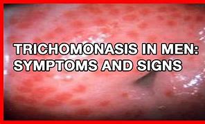Image result for Untreated Trichomoniasis in Men