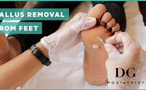 Image result for Plantar Callus Removal