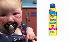 Image result for Baby Lotion Chemical Burn