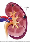 Image result for Simple Renal Cyst