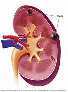 Image result for Renal Cyst