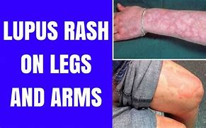 Image result for Viral Rash On Arms and Legs