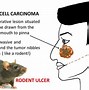 Image result for Cystic Basal Cell Carcinoma