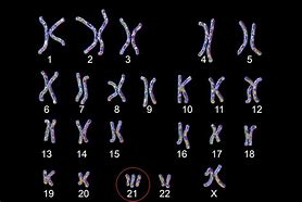 Image result for Down Syndrome Chromosome
