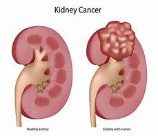 Image result for Large Renal Mass On Kidney