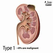 Image result for Lower Pole of Kidney Cyst