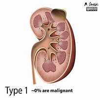 Image result for Large Renal Cyst