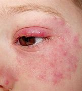 Image result for Skin Rashes around Eyes