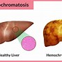 Image result for hemocromatosis