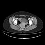 Image result for Ovarian Dermoid Cyst 10Cm