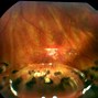 Image result for Central Serous Retinopathy Oct