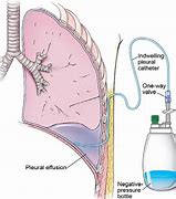 Image result for Chest Tube Parts