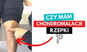 Image result for chondromalacja