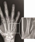 Image result for Broken Arm Hand