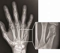 Image result for Broken Finger Bone