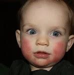 Image result for Fifth Disease Rash Baby