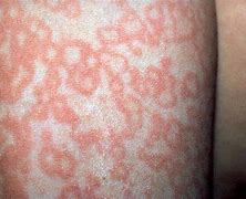 Image result for Fifth Disease Stages