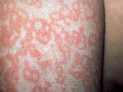 Image result for Fifth Disease Rash Symptoms