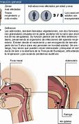 Image result for adenoides