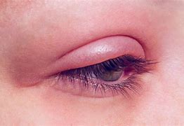 Image result for Red Swollen Eyelid