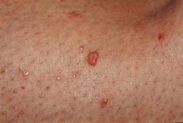 Image result for Flat Warts On Skin