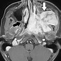Image result for Cavernous Sinus Syndrome