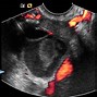 Image result for Cyst On Right Ovary