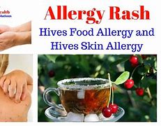 Image result for Food Allergy Hives