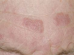 Image result for Plaque Skin Lesion