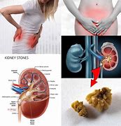 Image result for Kidney Stone Abdominal Pain