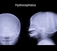Image result for Hydrocephalus Skull