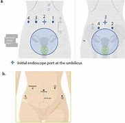 Image result for Robotic Hysterectomy Port Placement