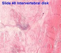 Image result for ontervertebral