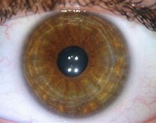 Image result for Concentric Circles in Eyes