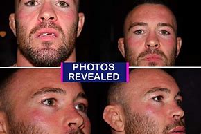 Image result for Colby Covington Teeth