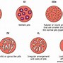 Image result for Colon Polyp Size Chart 3Mm