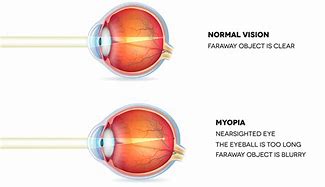 Image result for Myopia Light Rays