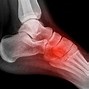 Image result for Lisfranc Joint Injury
