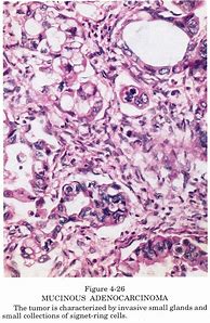 Image result for Mucinous Ovarian Carcinoma