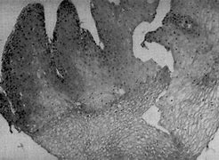 Image result for Verruca Vulgaris Pathology