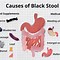 Image result for Black Stool and Stomach Pain